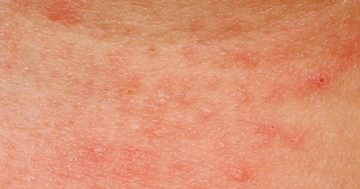 Close-up of red, irritated skin with eczema patches